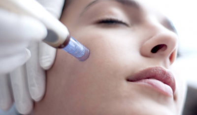 Microneedling Treatment on Face
