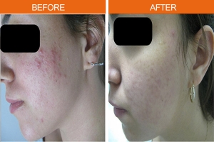 IPL Acne Therapy Before & After