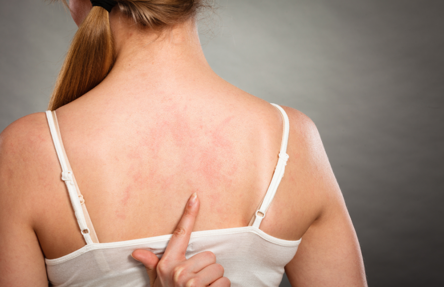 Woman with Eczema on Back