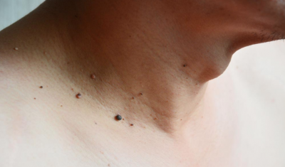 Skin Tags on Neck