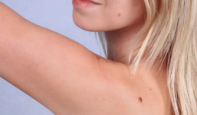 Woman with Skin Tag & Mole