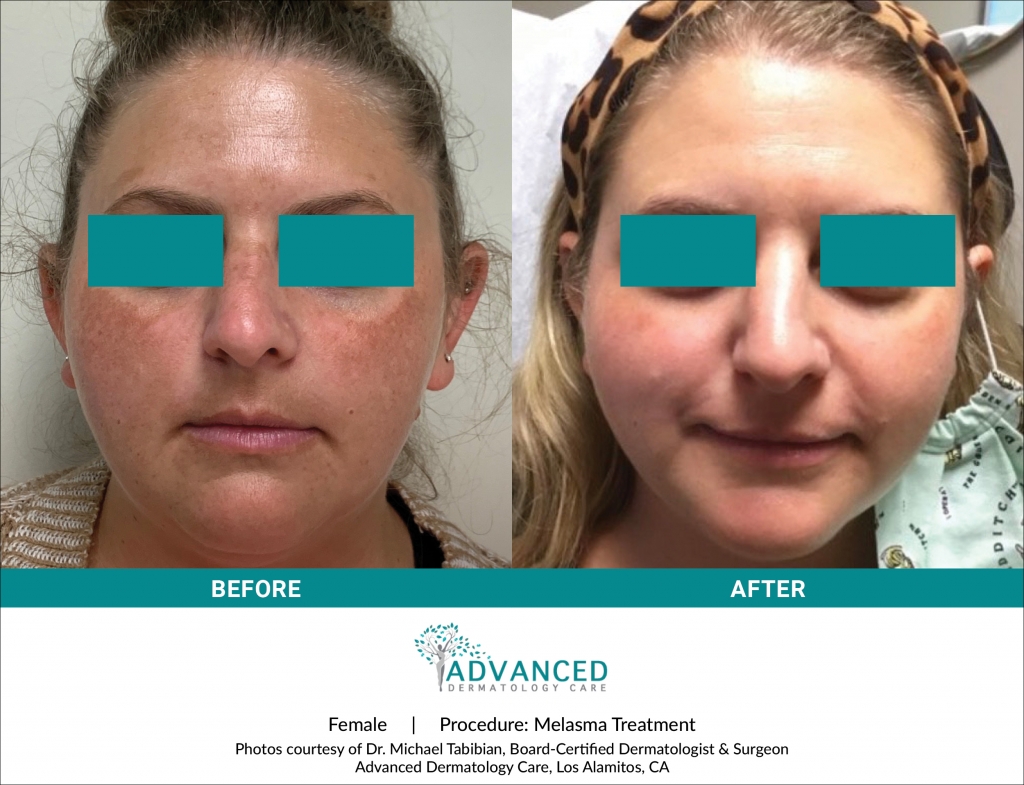 Before & After Melasma Treatment