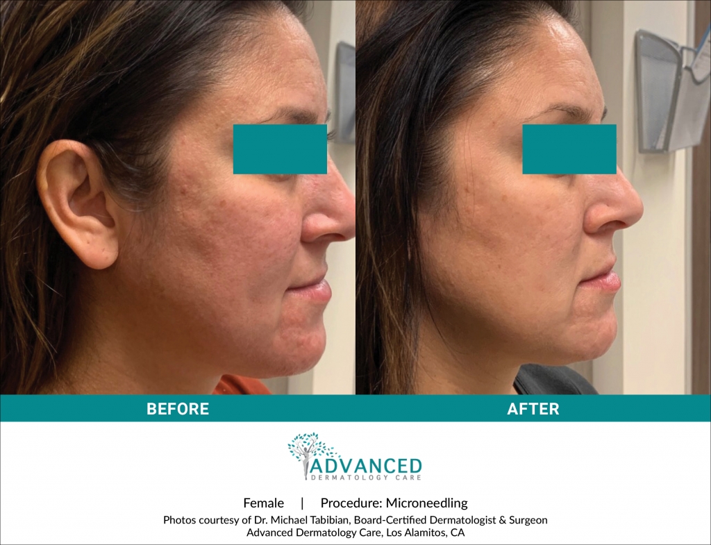 Before & After Microneedling