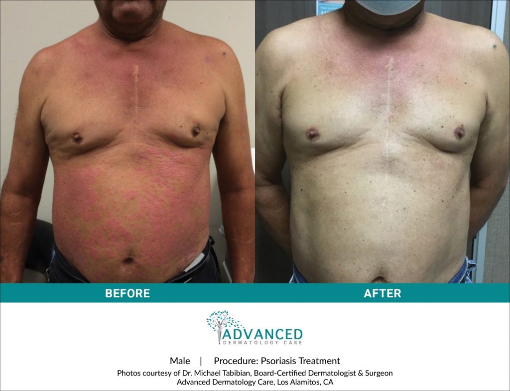 Before & After Psoriasis Treatment