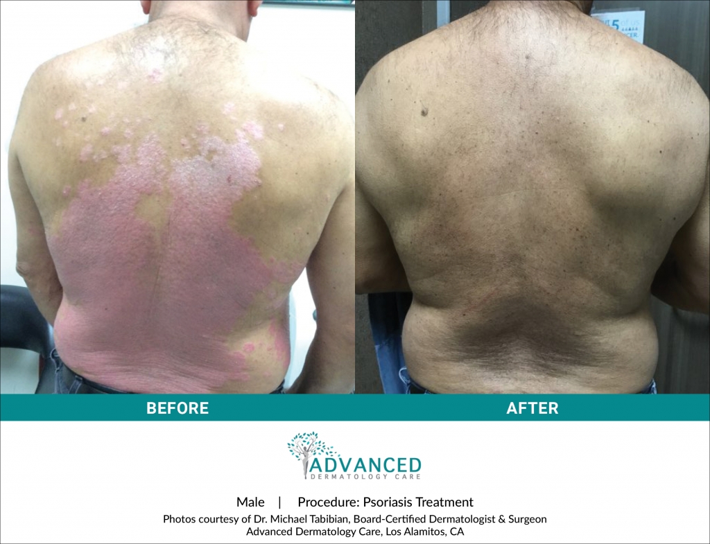 Before & After Psoriasis Treatment