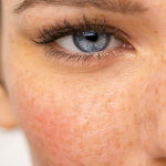 Female Skin with Hyperpigmentation