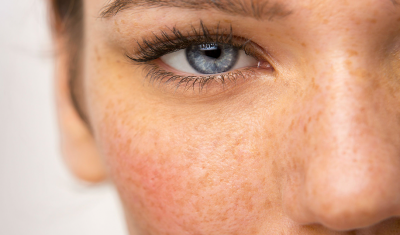 Female Skin with Hyperpigmentation