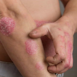 Person Scratching Psoriasis on Arm
