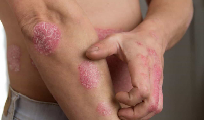 Person Scratching Psoriasis on Arm