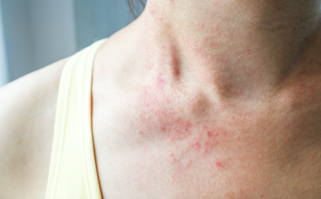 The Causes Of Red Bumps Advanced Dermatology Care