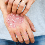 Psoriasis Scales on Hand
