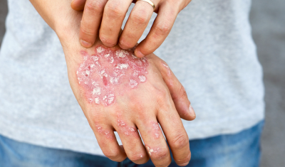 Psoriasis Scales on Hand