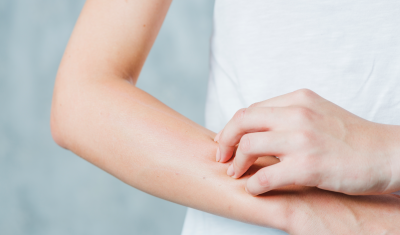 Eczema and Dry Skin
