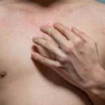 Hives on Chest