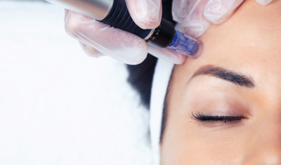 Microneedling for Acne